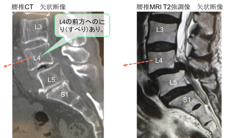 腰椎変性